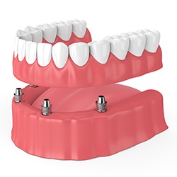 All-On-4 denture on lower arch