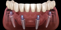 Digital image of a denture attaching to implants