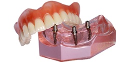 Model of implant denture