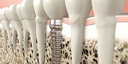 Digital illustration of a dental implant