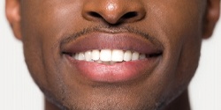Closeup of flawless smile with direct bonding in Denton 