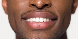 Closeup of flawless smile with direct bonding in Denton