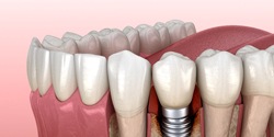 Diagram of a failed dental implant in Denton