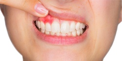 Woman showing her gums