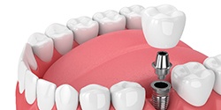 Dental implant in Denton