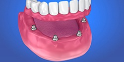 illustration of an implant denture on a patient’s lower arch 