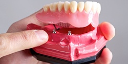 implant dentist in Denton holding a model of an implant denture 