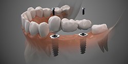 two dental implants supporting a dental bridge 