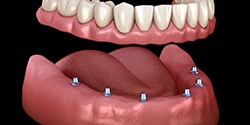 six dental implants supporting a full denture 