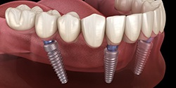 All-on-4 dental implants supporting a full denture 