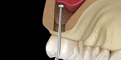 model of a sinus lift procedure