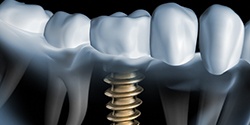 X-ray of a patient with a dental implant