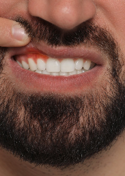 Man lifting the corner of his lip with one finger to reveal dark red gums