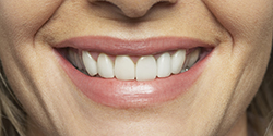 Close up of lady's healthy teeth