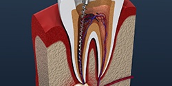 A 3D illustration of the root canal process