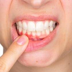 Gum Disease Therapy Denton Denton Dental Center Deep Cleaning