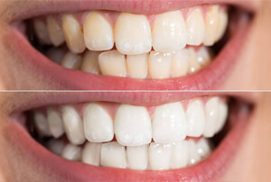 before and after teeth whitening