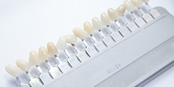 Dental veneers