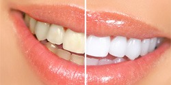 Before and after teeth whitening in Denton, TX