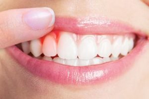 Woman smiling with dark red gums