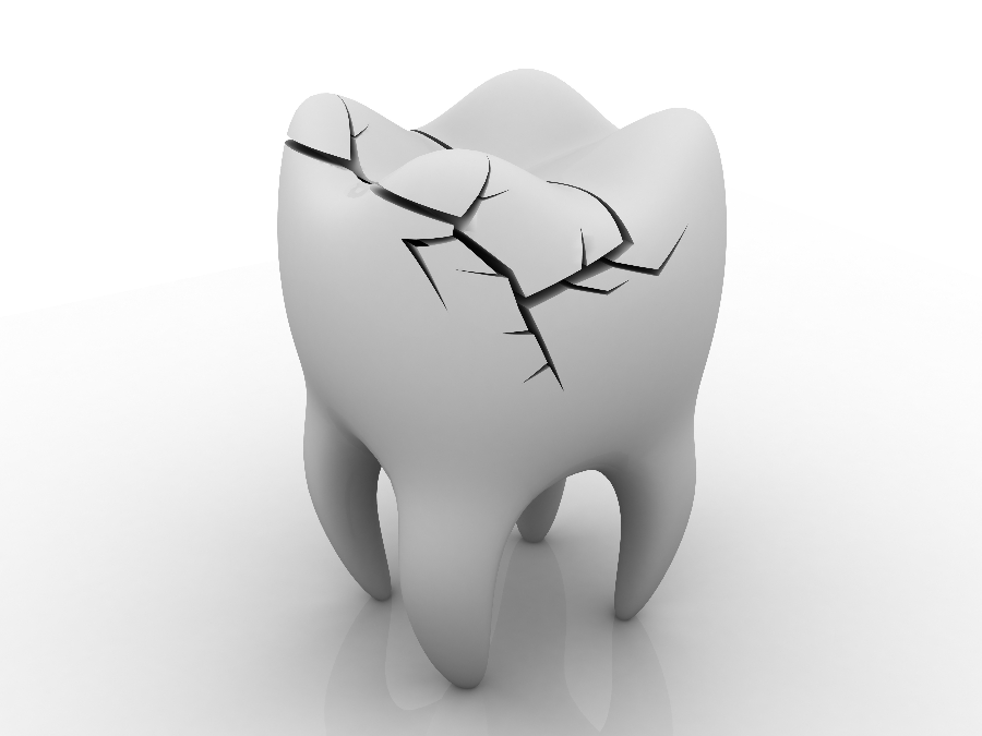 broken tooth - Denton Dental Center Blog