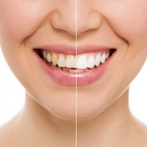 woman before and after teeth whitening