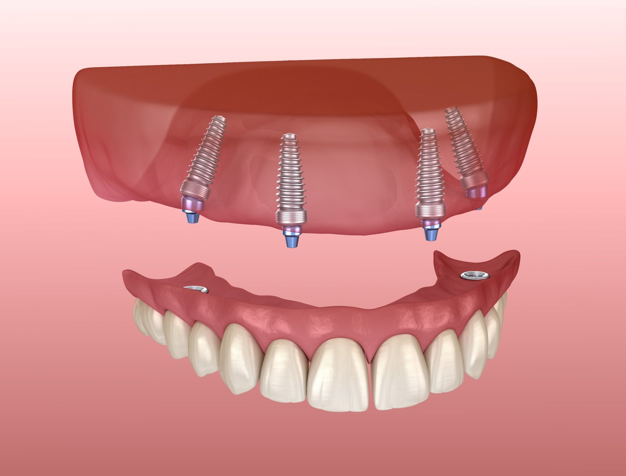 Benefits of ImplantRetained Dentures in Denton