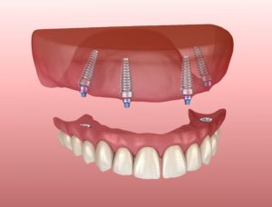 Digital model of implant-retained dentures in Denton.