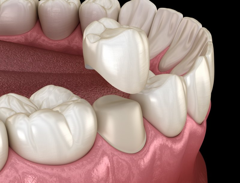 Diagram of a dental crown hovering over a modified tooth