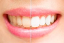 Side by side comparison of stained teeth and whitened teeth.