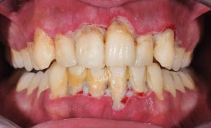 Patient with advanced gum disease