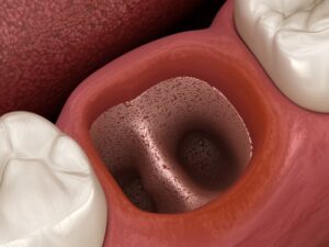 Dry socket. 