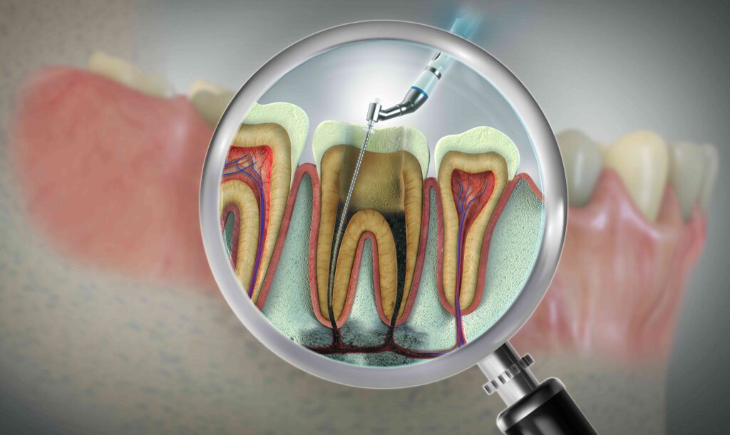 Root canal illustration