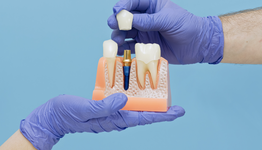 Dental implants